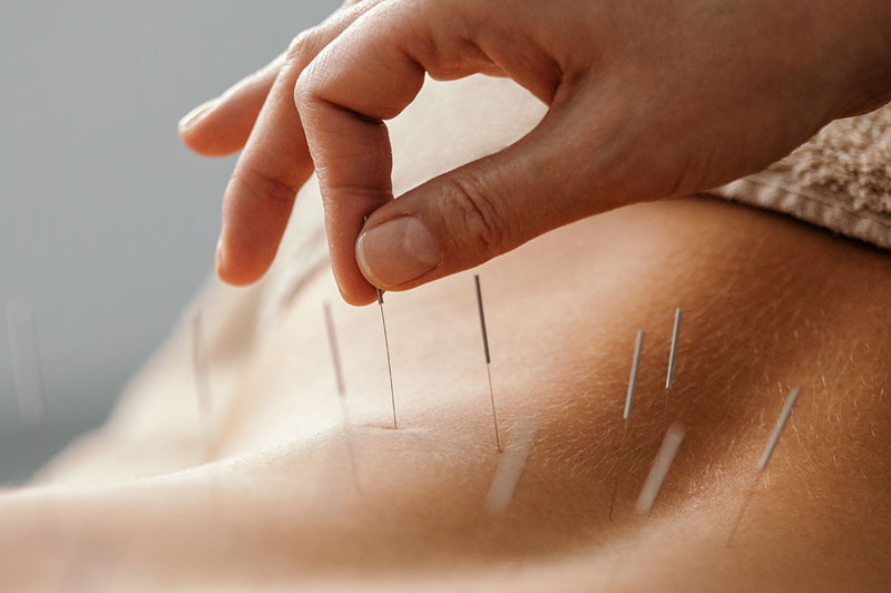 Acupuncture Merits
